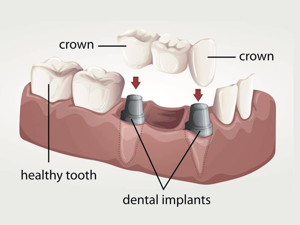 crown