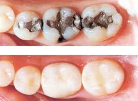 Before and after view of teeth restored with tooth-colored fillings