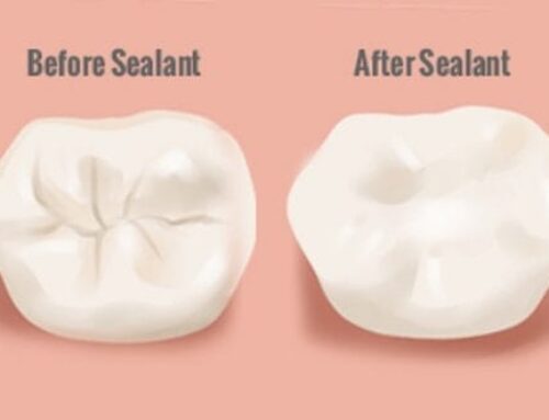 Unlocking the Benefits of Dental Sealants for Stronger Teeth in Littleton, Ken Caryl